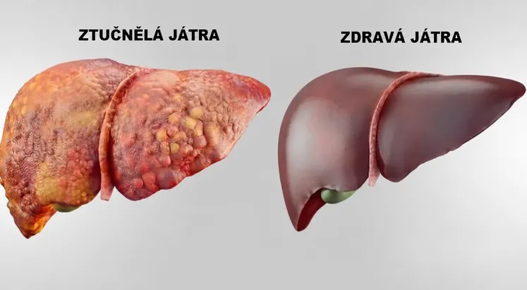 Ztučnělá játra vedle zdravých jater
